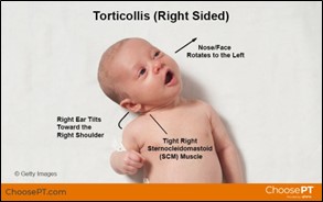 ChoosePT Torticollis